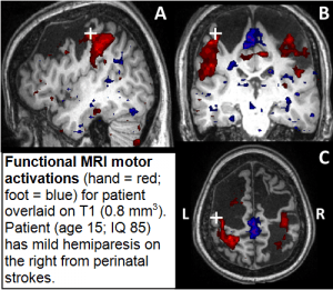 Functional MRI moter activations (hand=red; foot=blue) for patient overlaid on T1 (0.8mmcubed). Patient (age 15; IQ 85) has mild hemiparesis on the right from perinatal strokes.