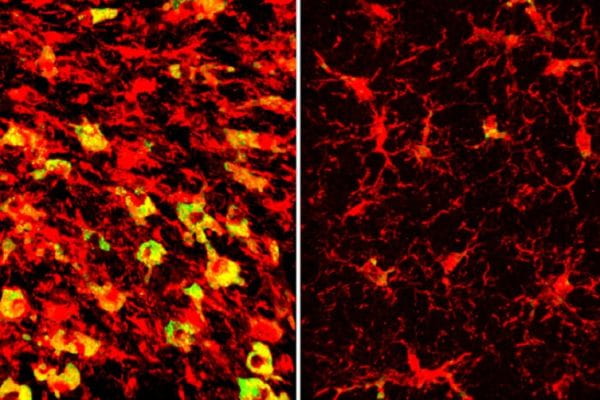 Lowering a form of brain cholesterol reduces Alzheimer’s-like damage in mice
